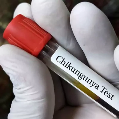 chikungunya test at SRG Hospital Jaipur